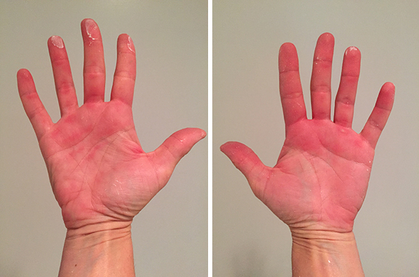 please note the difference in skin coloring between my arms and palms!