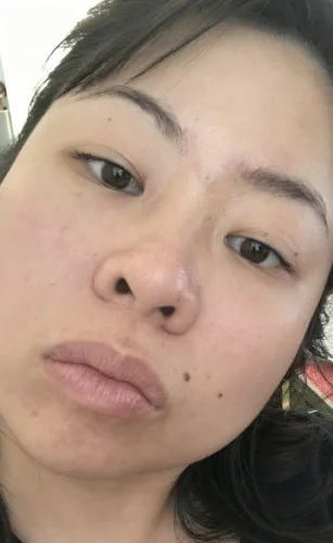 timeless vitamin c breakout reddit