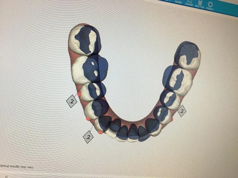 06PT-hal_Teeth moving.jpg