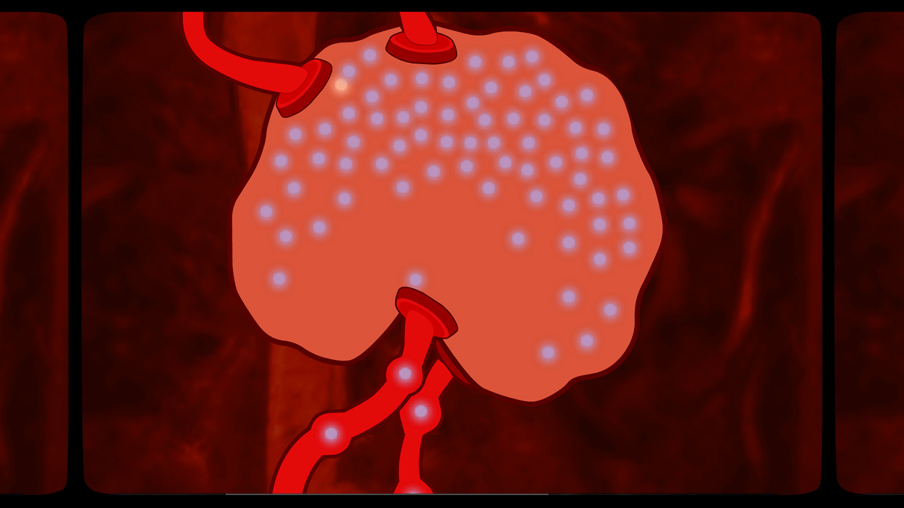 Portfolio-Rheum-Lupus-Lymph.jpg