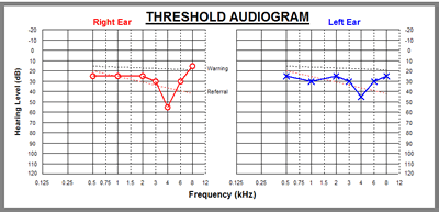 The red line (right ear) indicates a significant hearing loss at 4000HZ and the blue line (left ear) shows a loss, though not as dramatic, at the same frequency. the 4000 HZ level includes hearing of several vowels, consonants and especially those involving the letter "s".