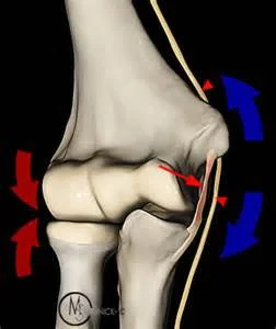 source: http://radsource.us/ulnar-collateral-ligament-tears-of-the-elbow/