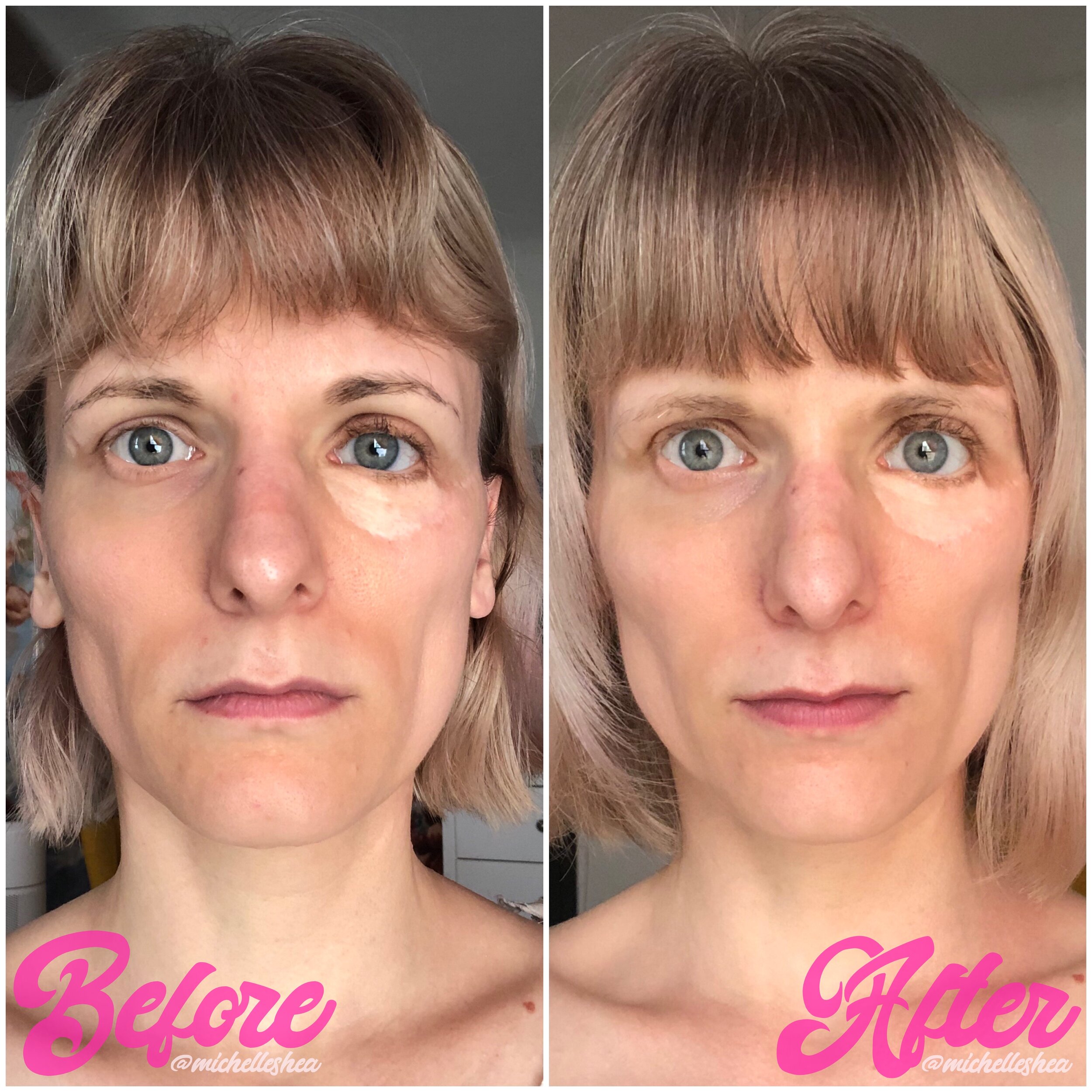 Mewing Before and After: Reclaim Your Confidence