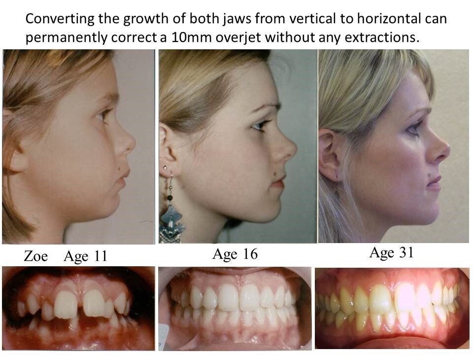 These tongue exercises called 'mewing' are so effective I don't do filler  anymore