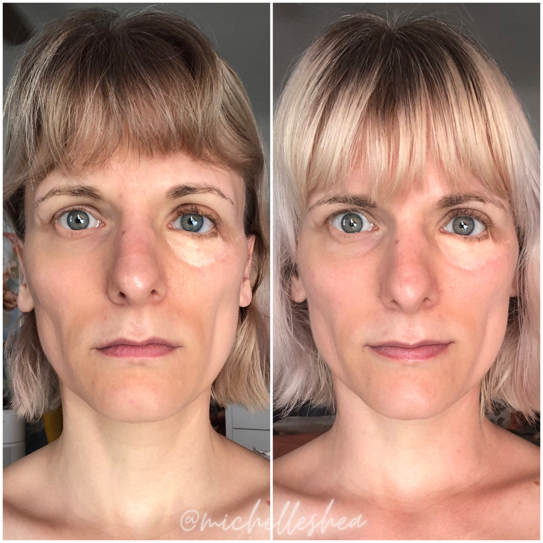 Mewing Tongue Before And After – IASVQ