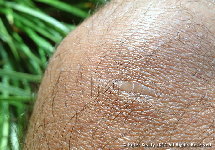 This is the scar on my knee from the hatchet. It's decades old but a constant reminder of the beauty of pain.