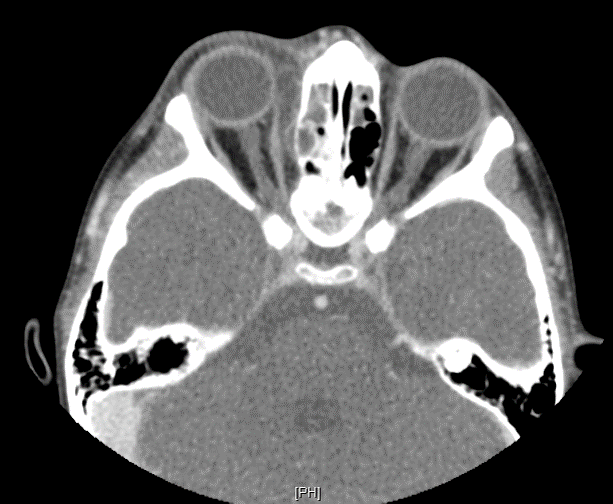 Brain and Spine