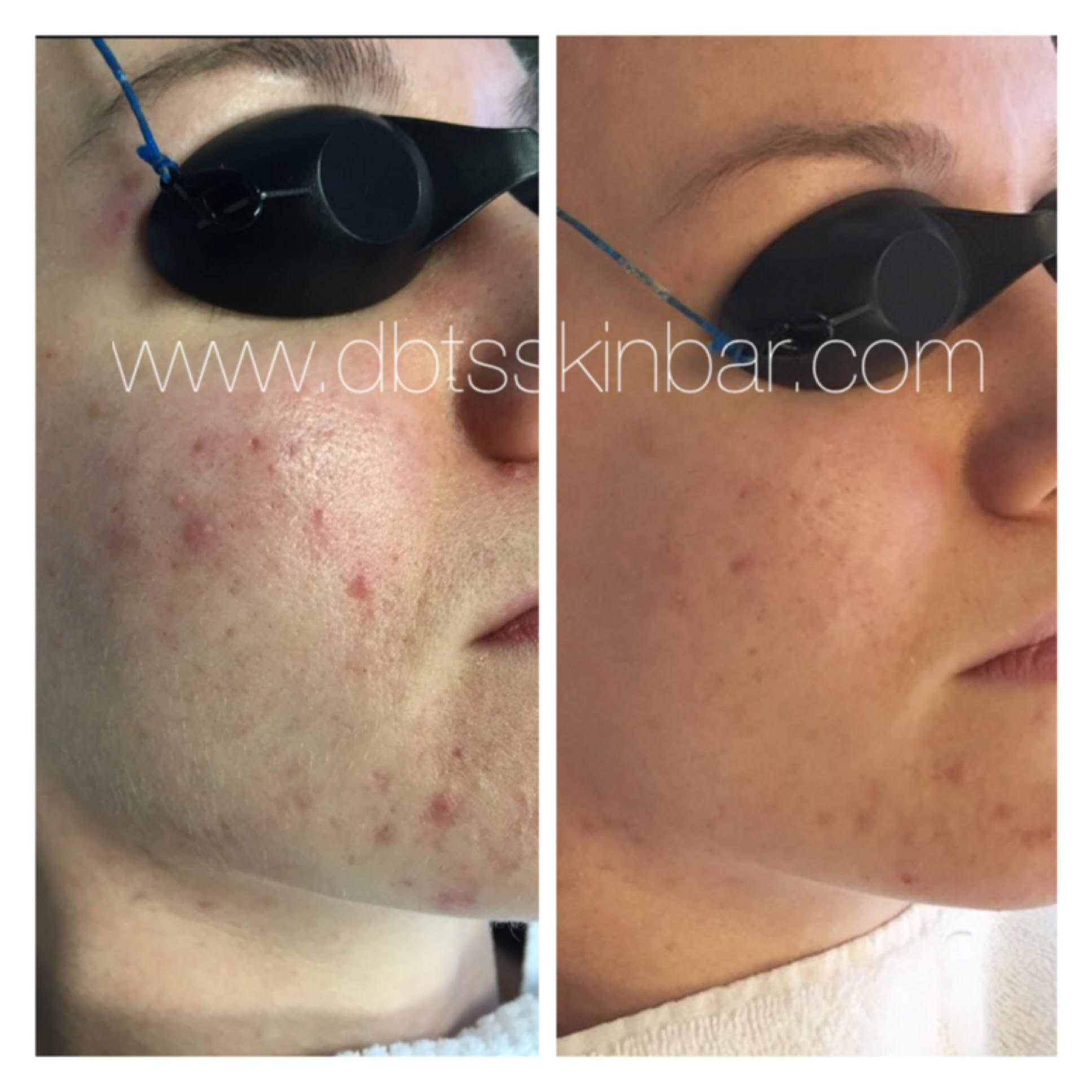 2 month progression: 4 chemical peels, complete Skin Bar Product Regimen, Dairy & Glunten Free