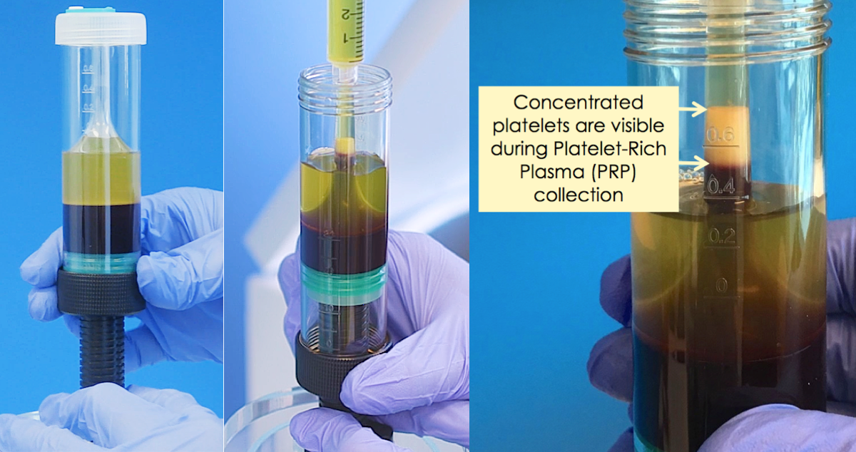 Platelet-Rich Plasma Medical devices and products — Alocuro ...