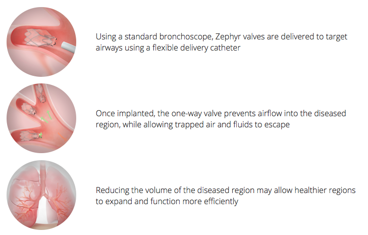 Image from www.pulmonx.com