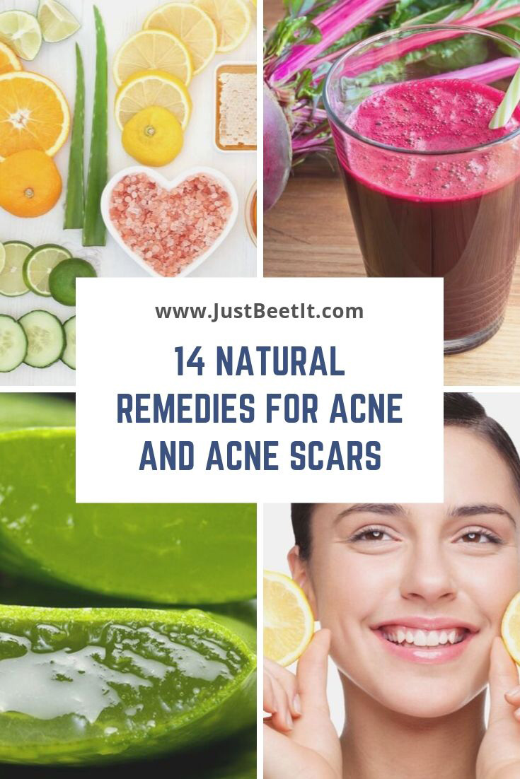 Home remedies to remove acne scars quickly