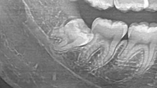 Coronectomy in Wisdom Tooth Surgery — Tropicana Dental Surgery
