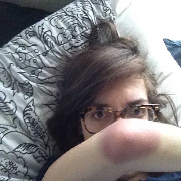 A picture of me with a mysterious bruise after the night yelling about hipsters. Hipster curse?