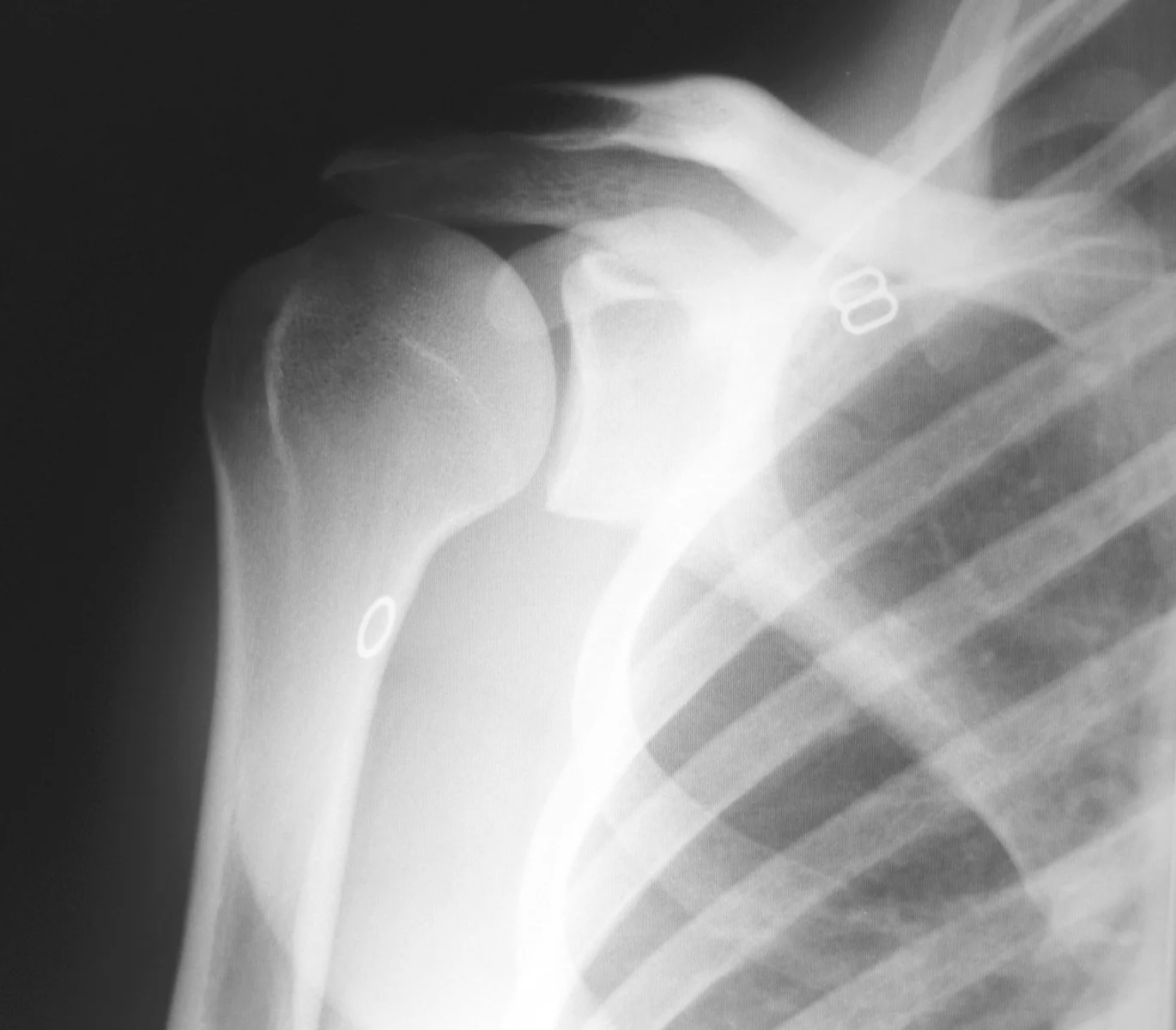 Arthritis — Dr. R. Edward Glenn, Jr.