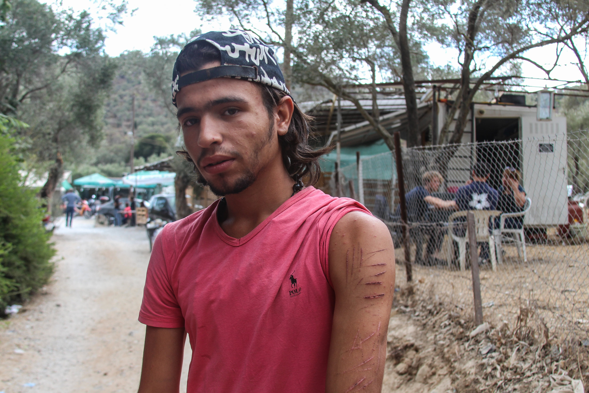  A Syrian migrant shows his wounds after allegedly being beaten by Greek police in the Moria Refugee Camp. Countless others were also injured in a riot that destroyed over 60% of the facility. The riots were initiated by refugees due to internal raci