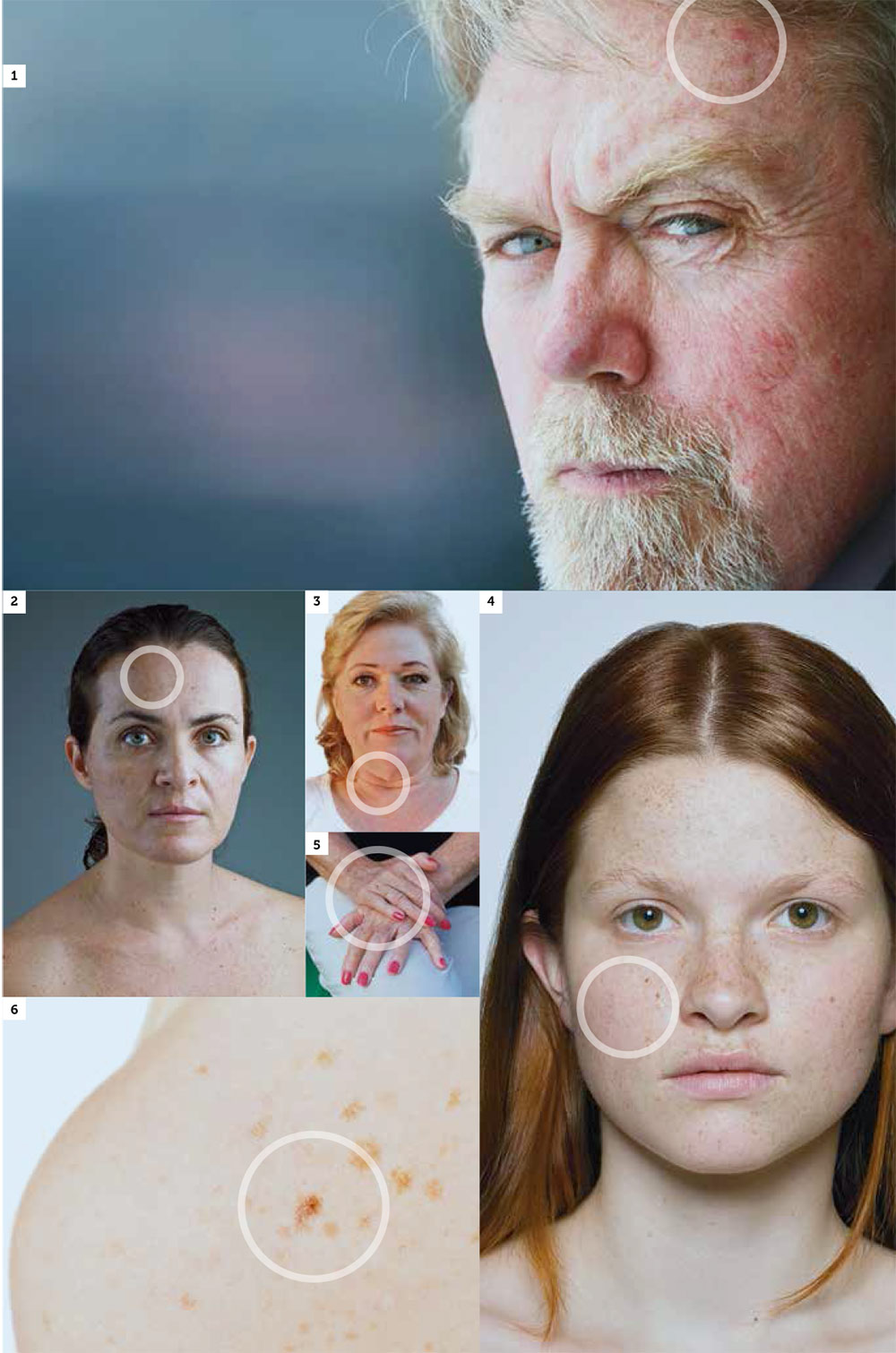 The deleterious effects of the sun are responsible for up to 90 per cent of skin aging. Pictured opposite, some early signs of photoaging include: (1) sun-related keratosis; (2) pigmented spots; (3) deep wrinkles; (4) freckles; (5) age spots; (6) solar lentigines.