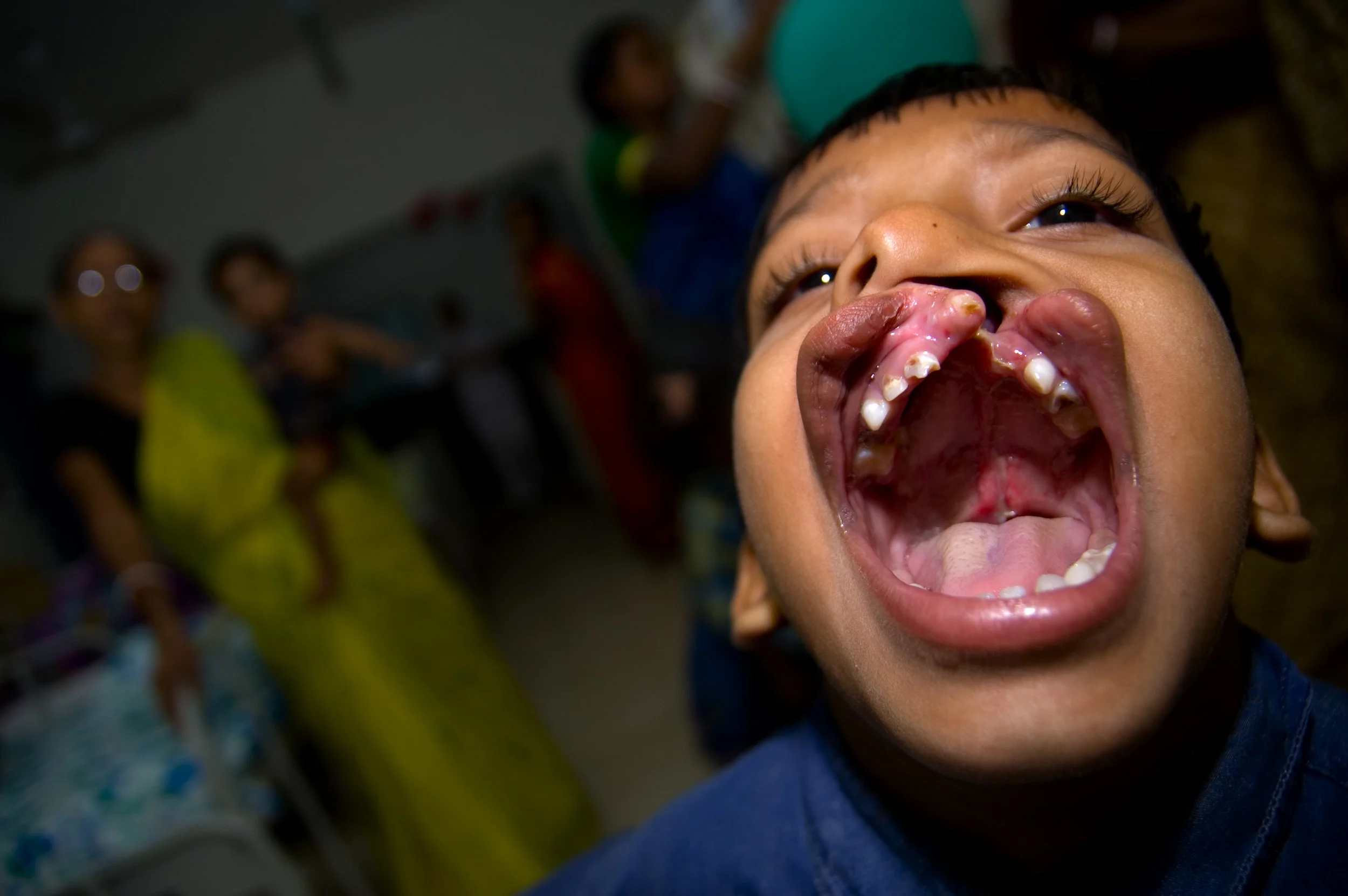 CLEFT PALATE SURGERY — Calcutta Mercy
