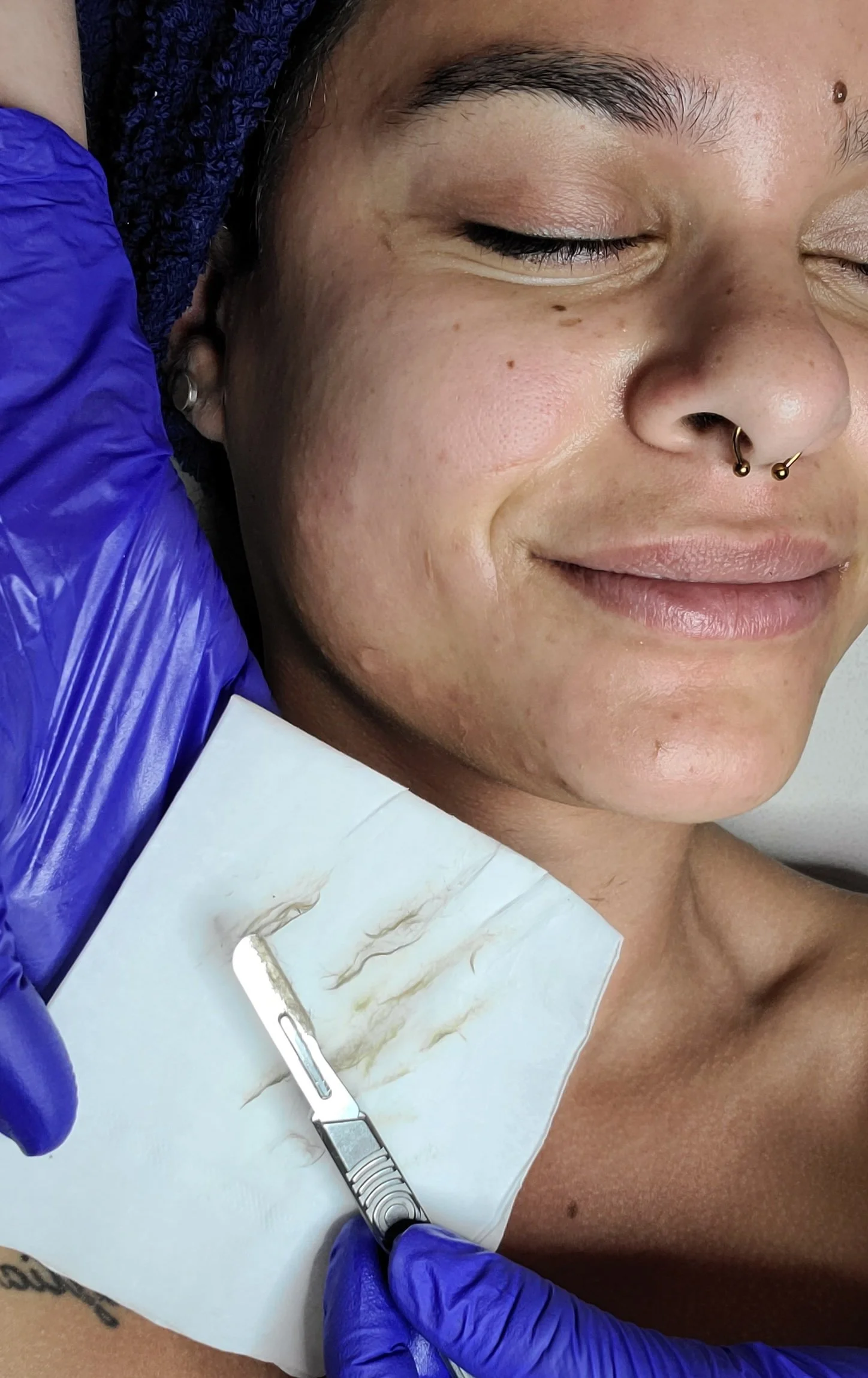 DERMAPLANING - What, How, Why, When
