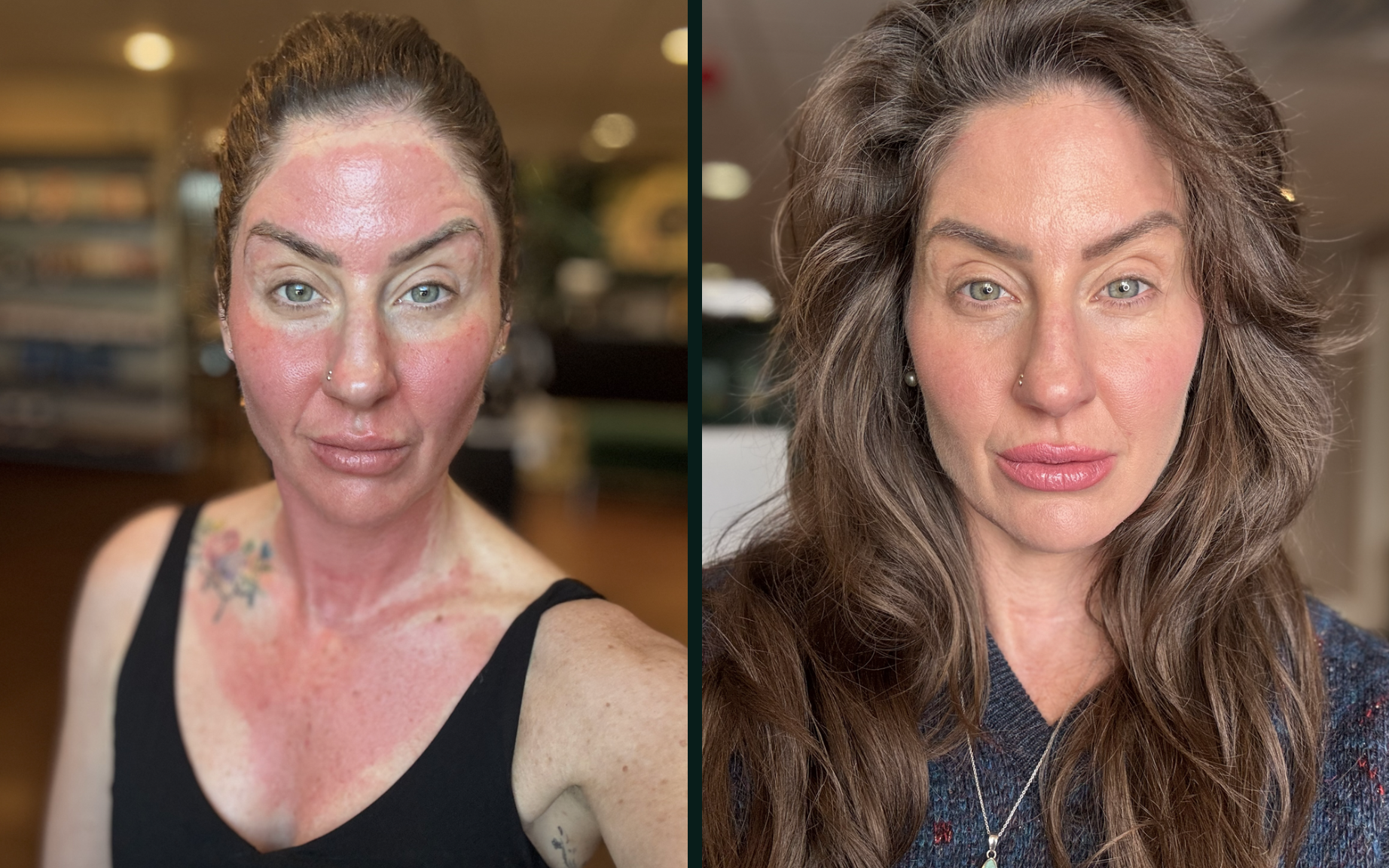 What to Expect After Microneedling: Your Day-by-Day Skin Healing Guide