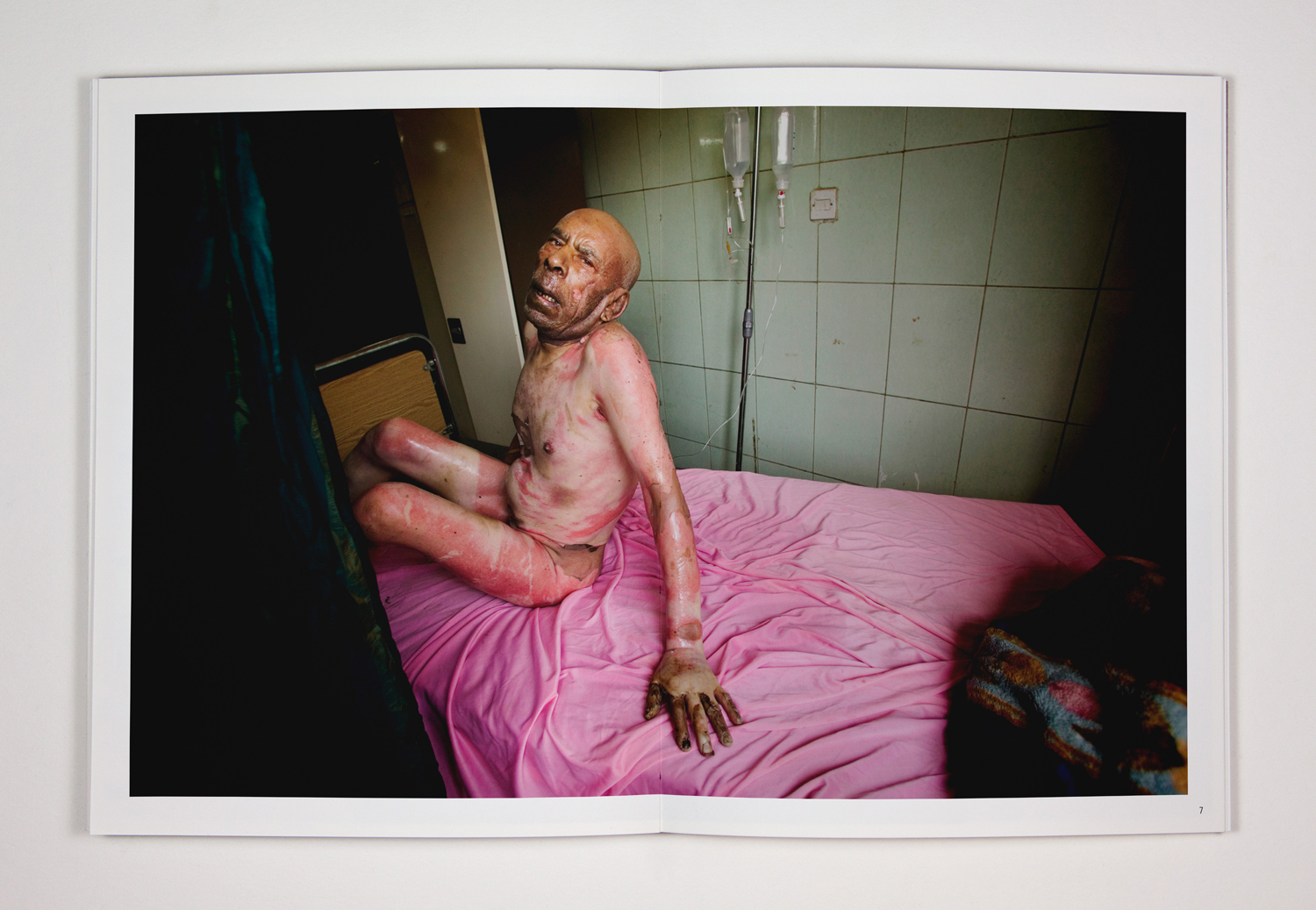 11. A severely burned elderly man in great pain at Yamouk´s emergency room as he waits to be transferred to another hospital. Yarmouks burn unit is closed, and doctors blame corruption in the Ministry of Health for the lack of funds to reopen it. A doctor told me that the old man would probably die because no other hospital with a burn unit would admit him. 28. August 2005, Bagdad. Iraq