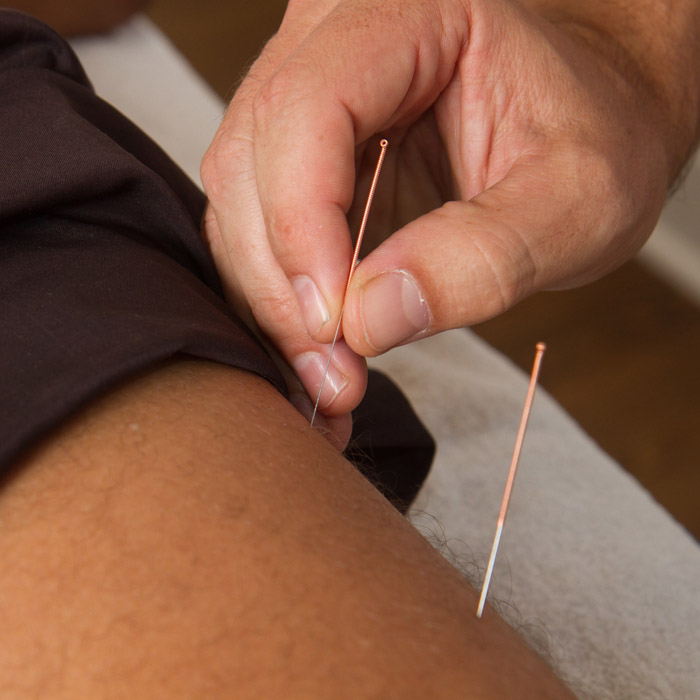Dry needling