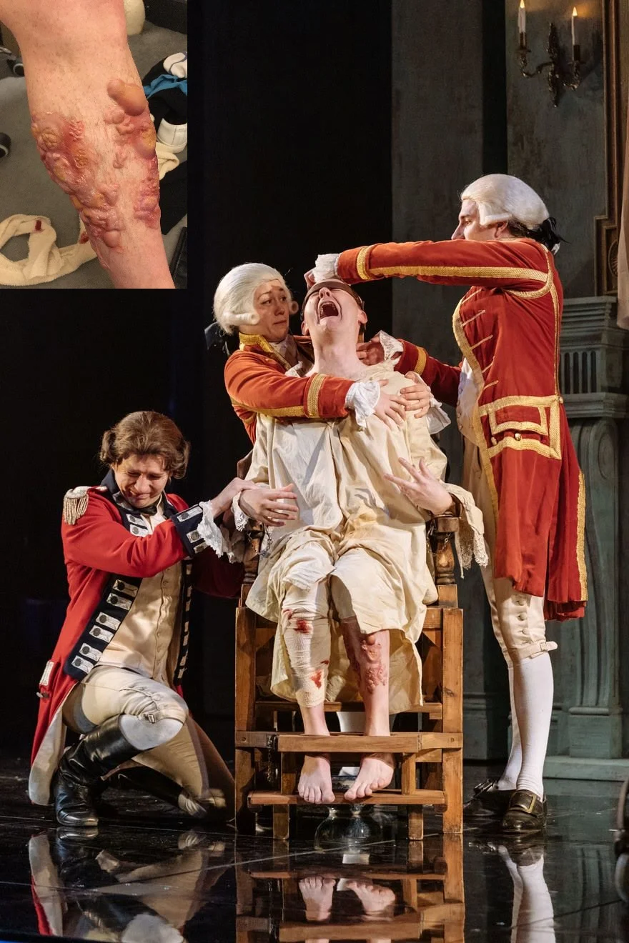 Blister prosthetics for 'The Madness of George III'