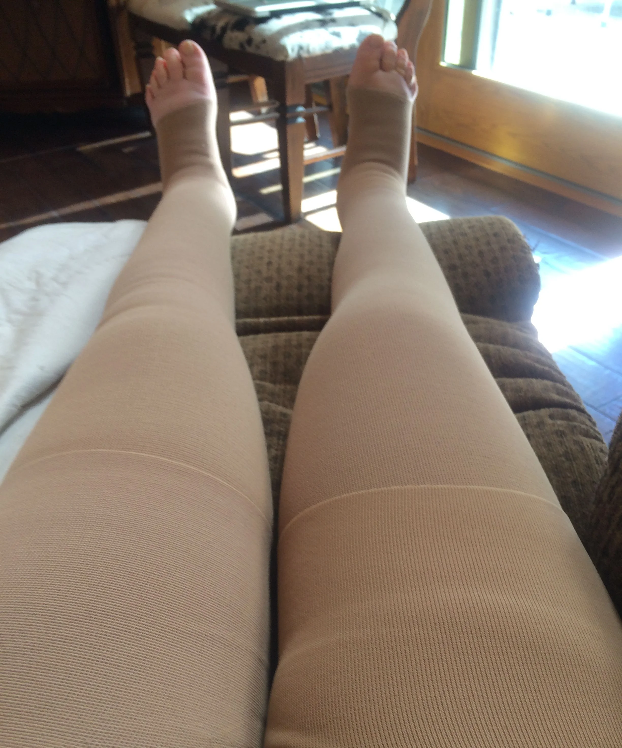 Two weeks after liposuction surgery.