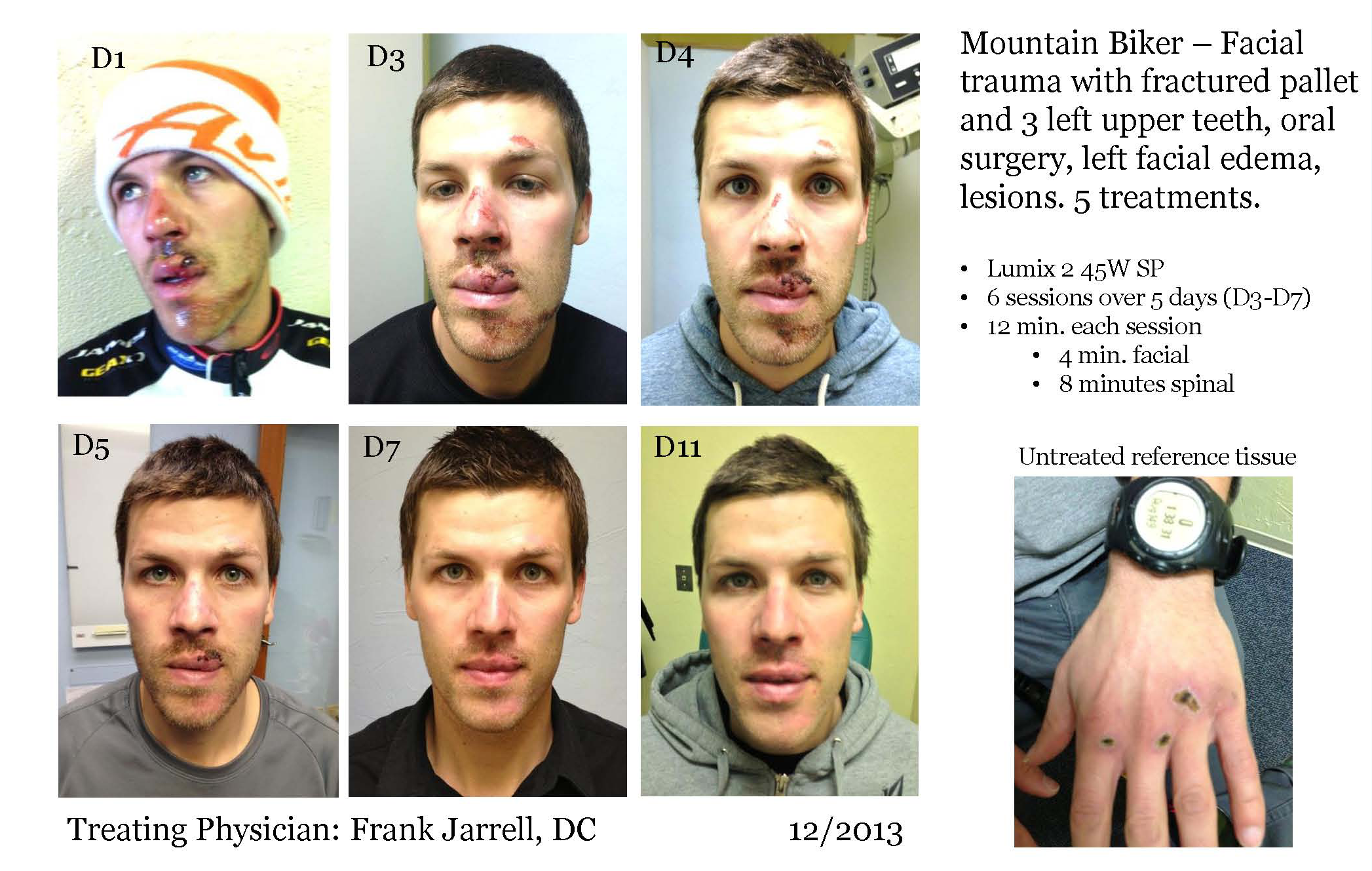 Lumix Laser Wound Healing - SRI