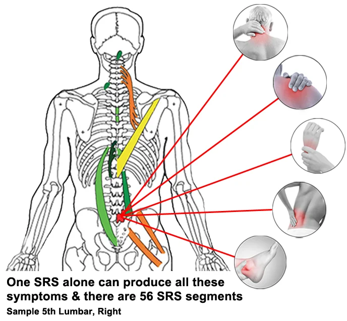 Spinal Reflex L5R sample