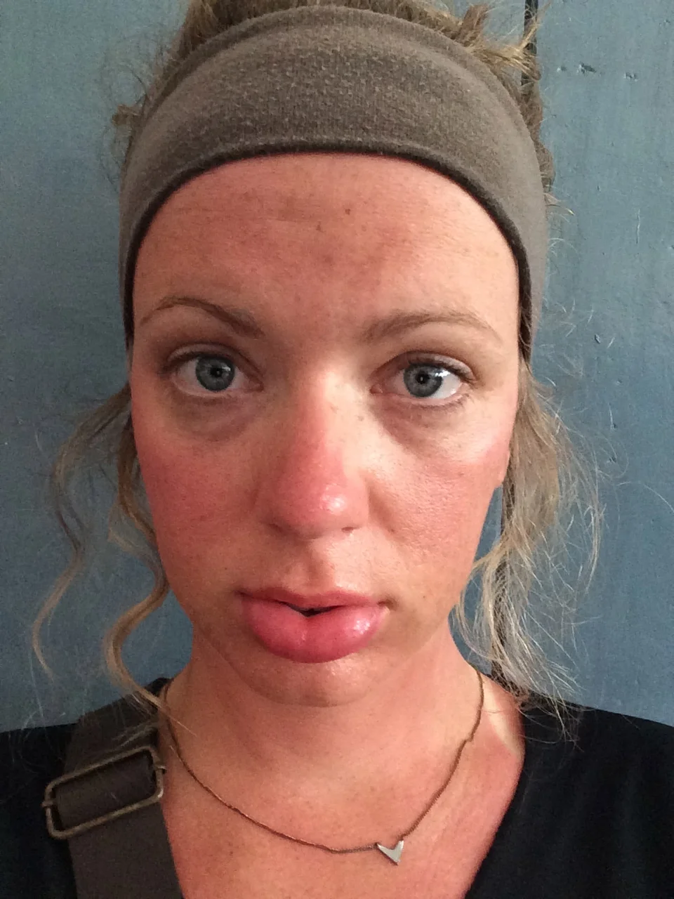 The only sunburn I’ve gotten in SE Asia...on my lips. Apparently I didn’t put enough sunscreen on them and they swelled to twice their size. My celeb status just rose to B list. 