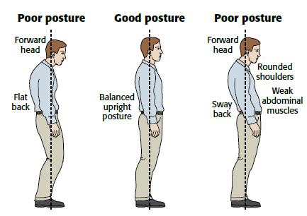 Symptoms, Causes and Treatment of Bad Posture