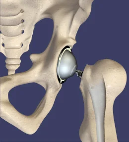 Hip-replacement.jpg