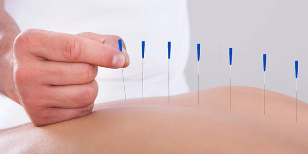 Best Dry Needling Treatment In Tardeobest Dry Needling Treatment Near Me