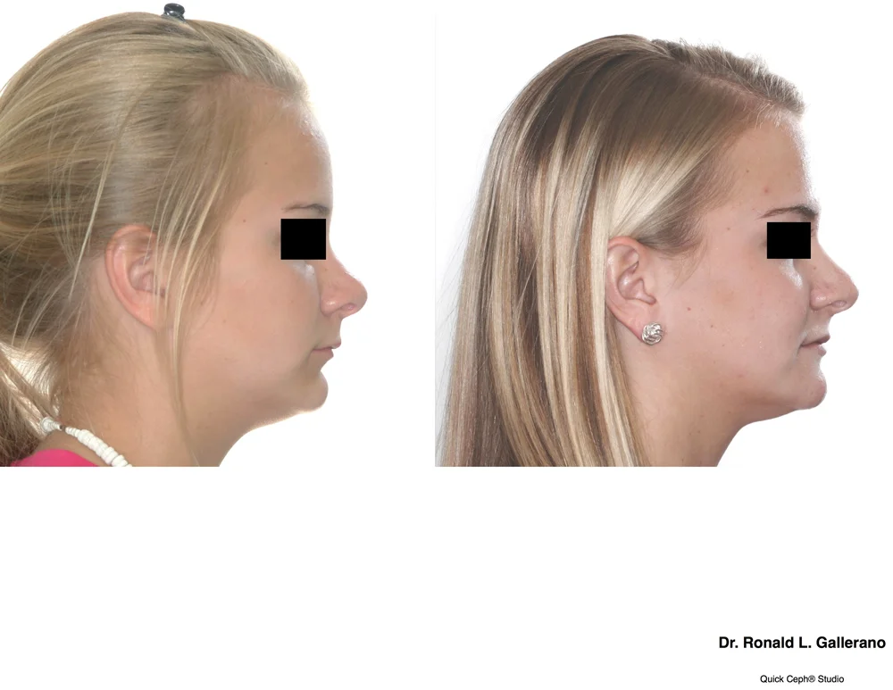 Overbite Before And After Profile