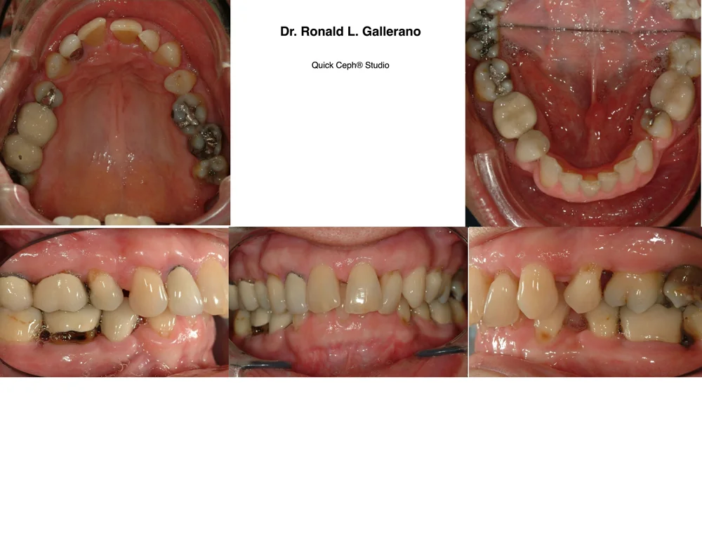 M.D. (45) - Before