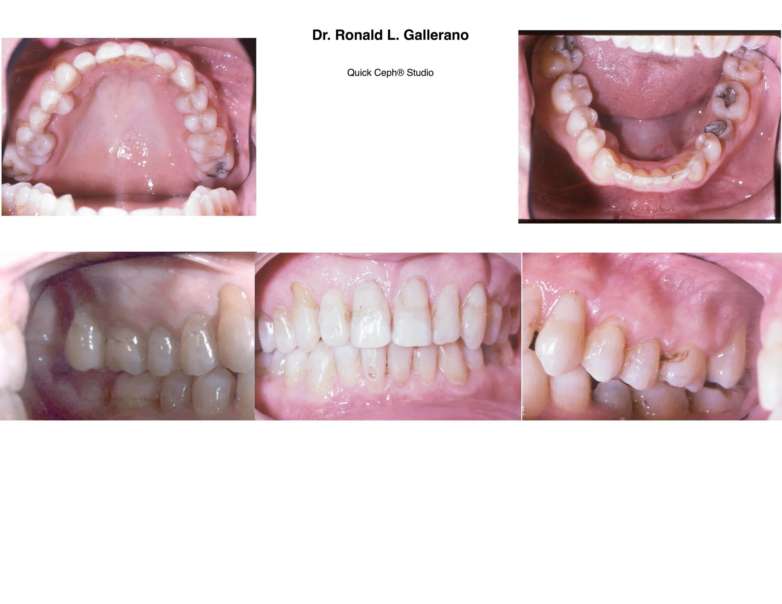 G.H. - After orthodontics