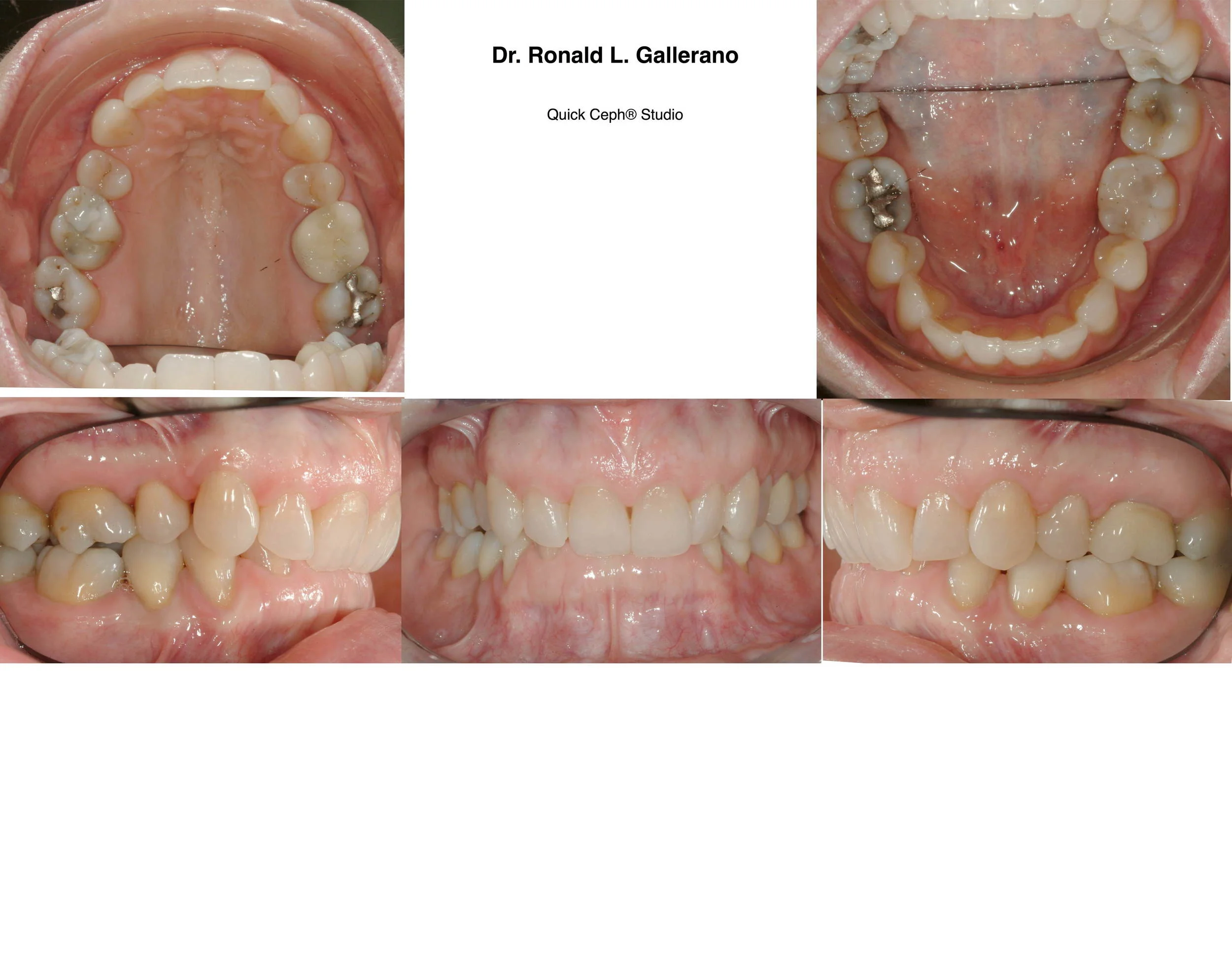 L.C. (52) - Before