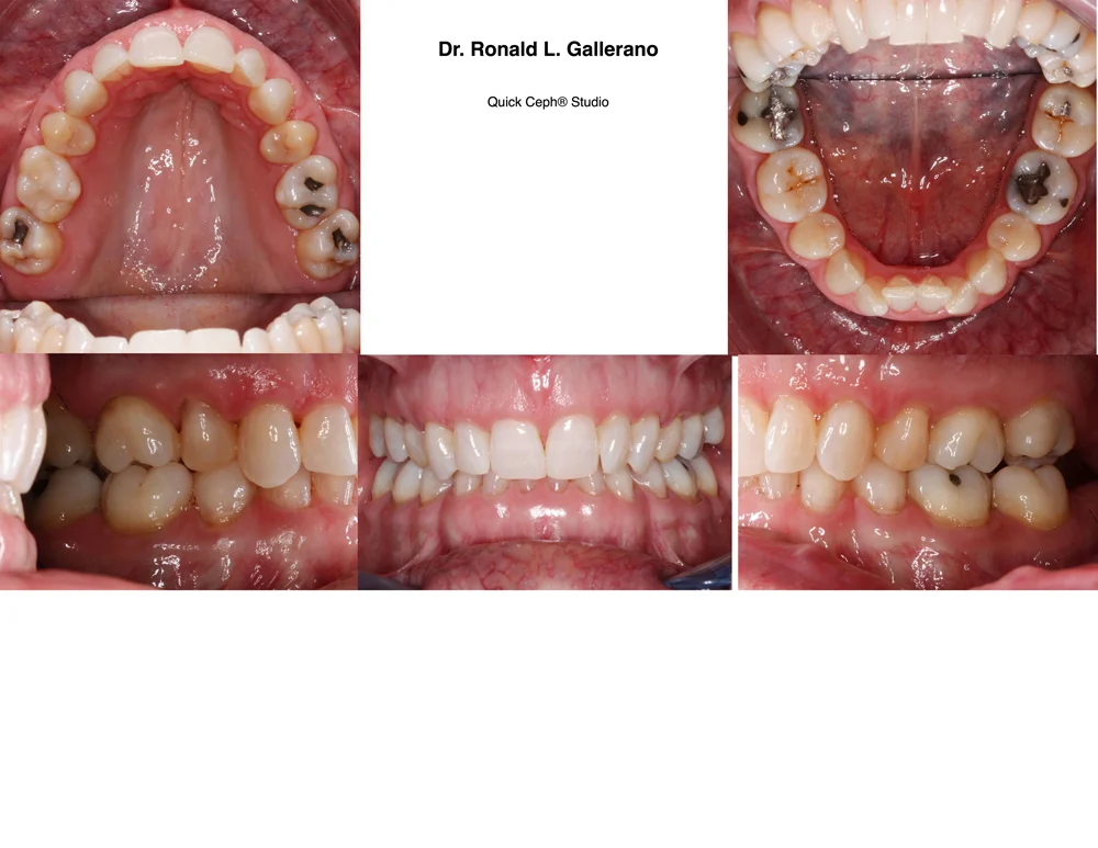R.J. (55) - Before