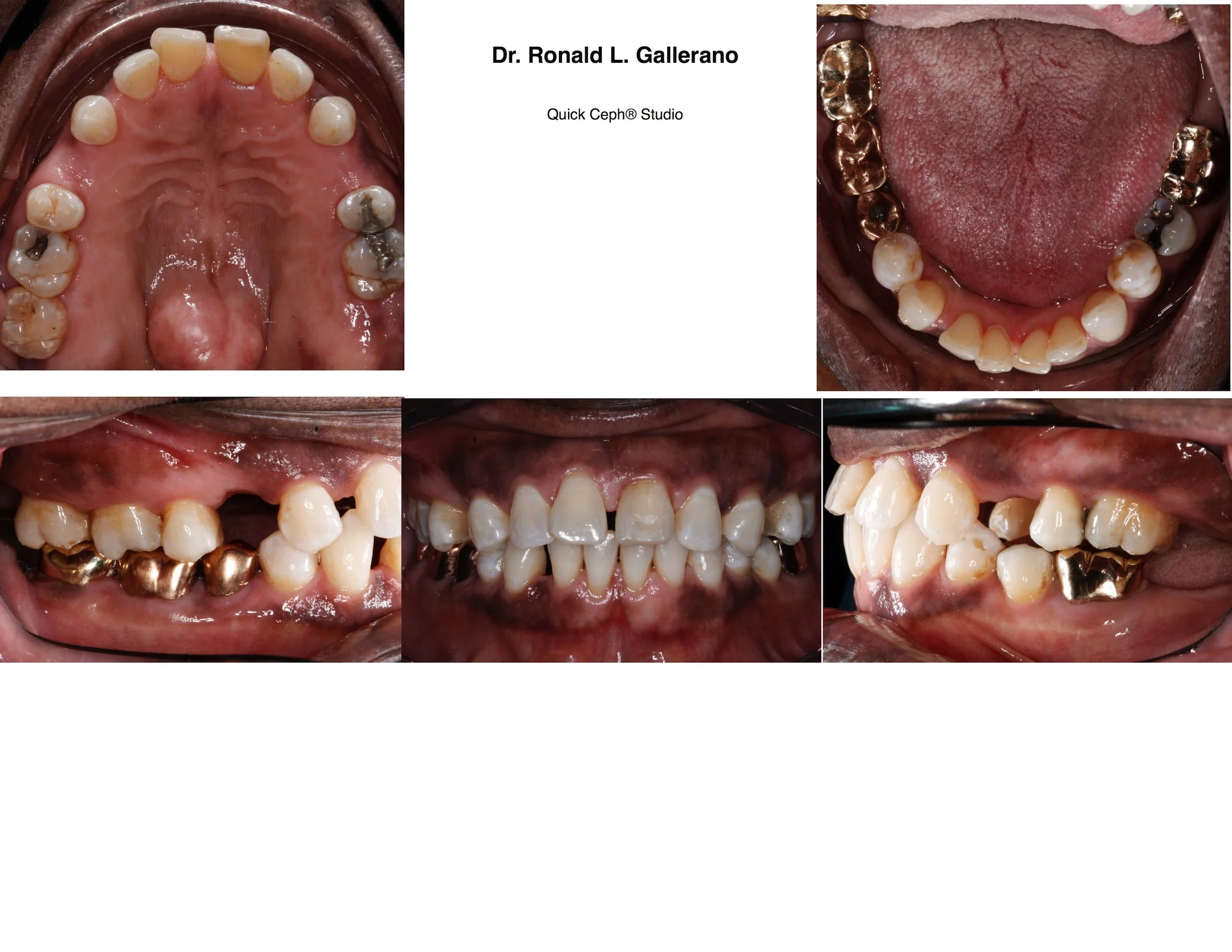 M.C. (64y, 9m) Before