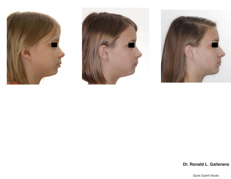 T. F. - Profile comparison