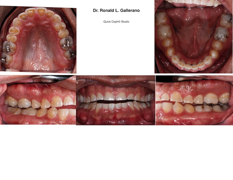 T.R. (48) After ortho