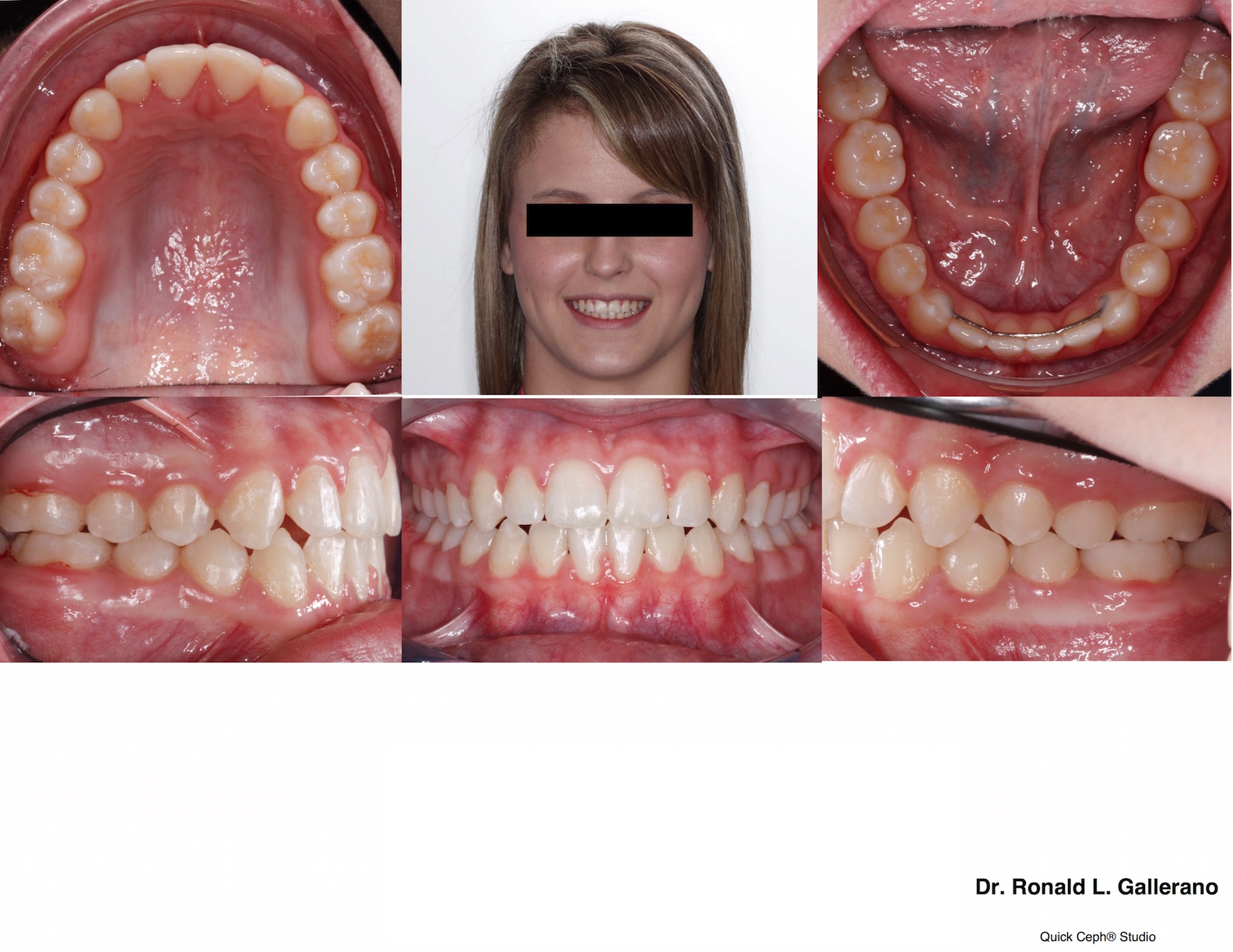 T. W. (15y, 3m) post braces