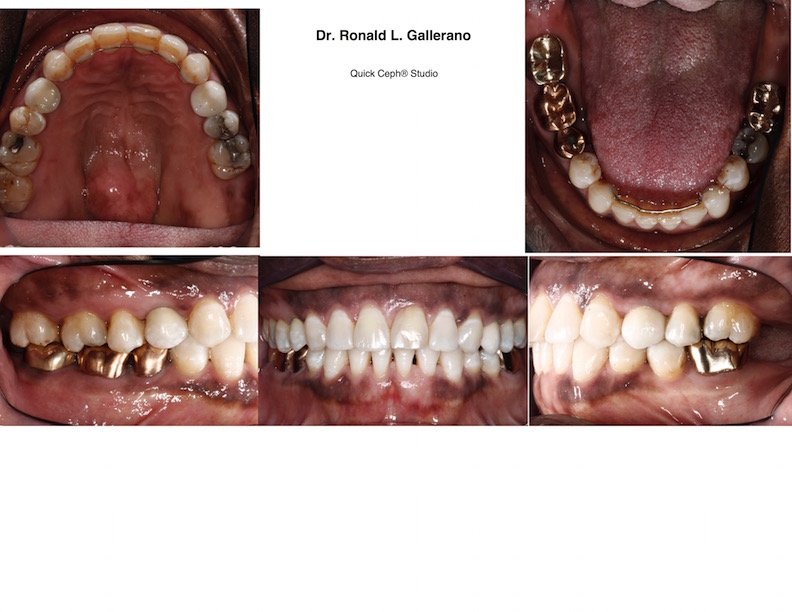 M. C. (68y, 9m) After restorations