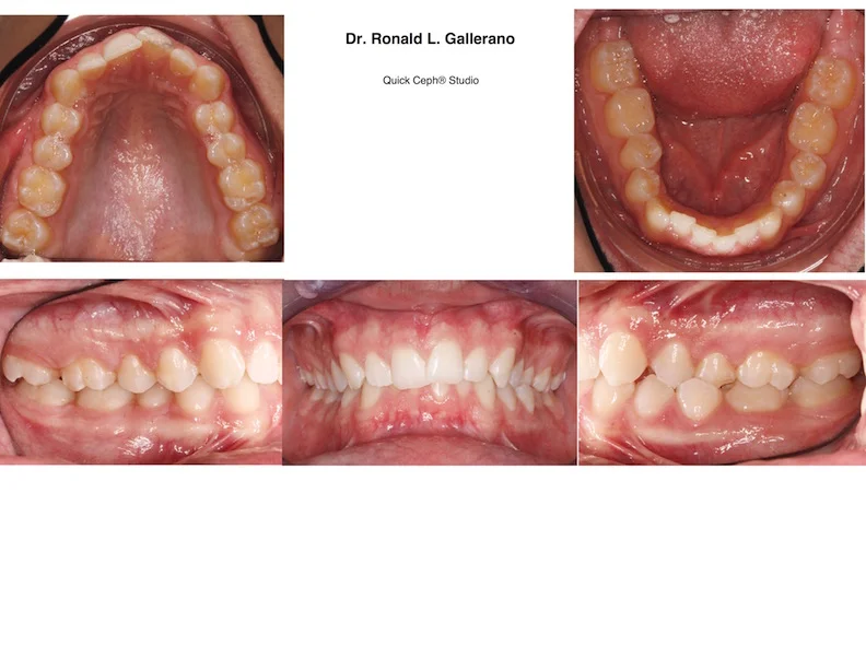 J. P. (18y, 9m) Before