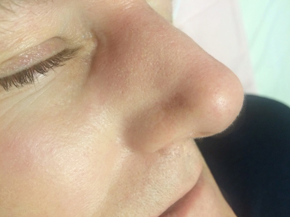 After Procedure