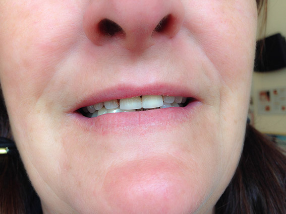 Full Lip Colour Before
