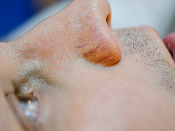 Before Procedure