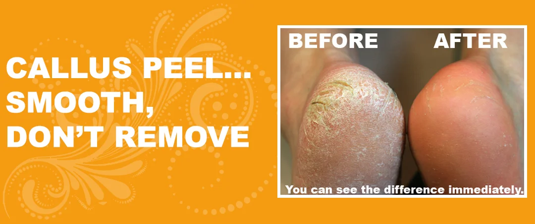 callus_peel.jpg