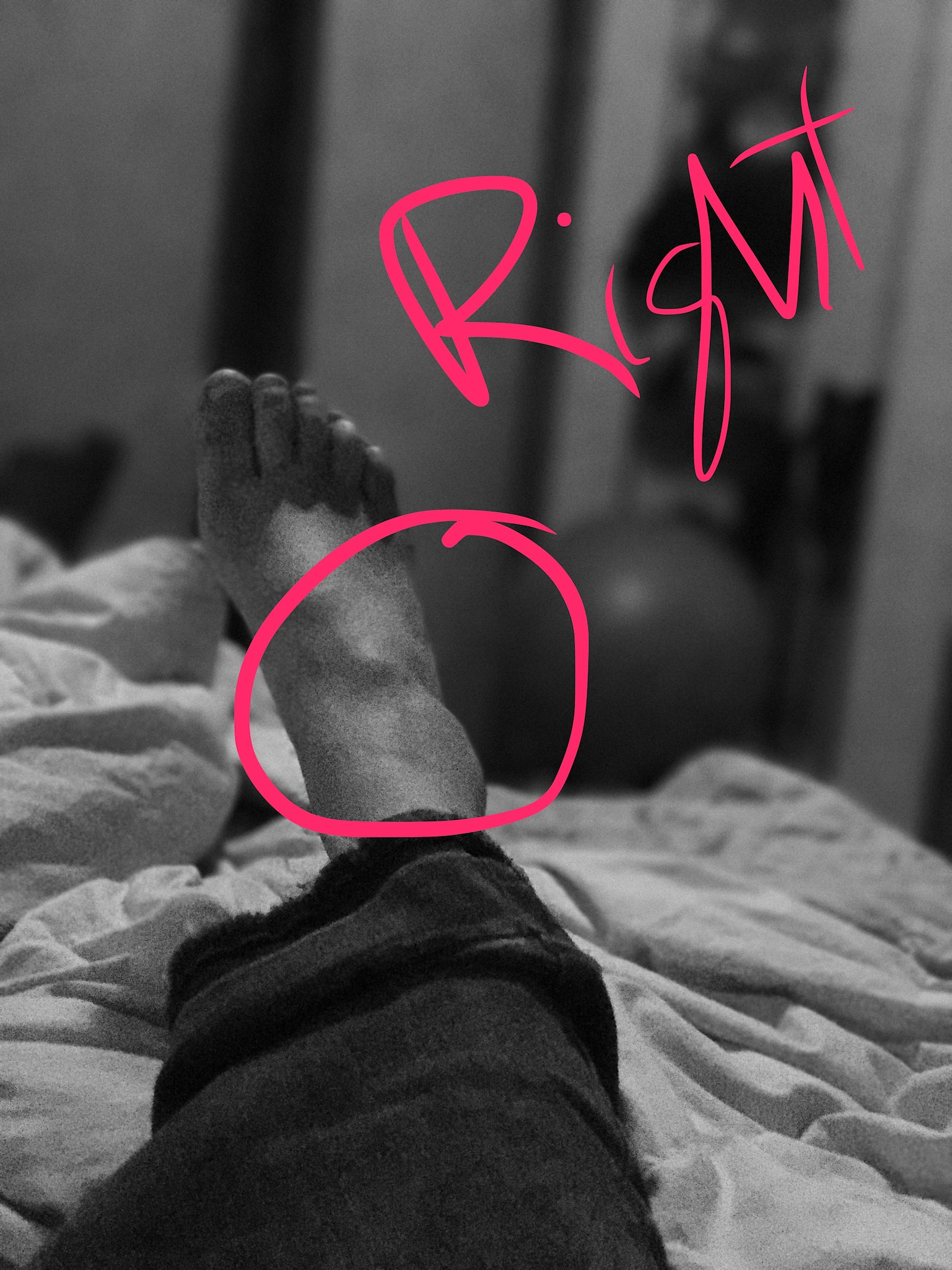 Ehlers Danlos Foot Dislocation
