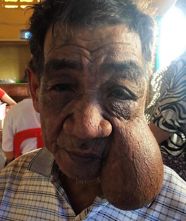 This poor man was very unfortunate with an old broken wrist that had not been aligned properly, and had this terrible growth on his face 😢 #connectwithcambodia